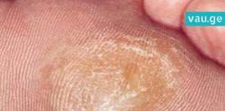 როგორ მოვიშოროთ კოჟრები სწრაფად და მარტივად? ხერხები, რომლებიც ბევრს გამოადგება