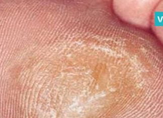 როგორ მოვიშოროთ კოჟრები სწრაფად და მარტივად? ხერხები, რომლებიც ბევრს გამოადგება