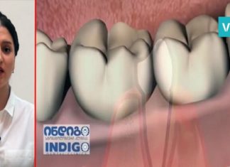 როგორ გავაქროთ უსიამოვნო სუნი პირის ღრუდან. რჩევა რომელიც ყველას გჭირდებათ!