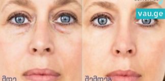 7 რჩევა, რომლებიც თვალების ირგვლივ სიშავესა და შეშუპებას მოგაცილებთ.. გაახალგაზრდავდით!