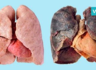 ეწევით? მაშინ ეს 4 რჩევა თქვენთვისაა. გაიწმინდეთ ფილტვები სწრაფად და მარტივად