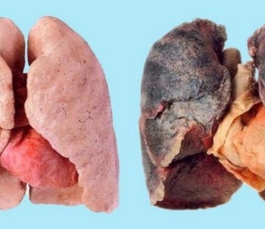 ეწევით? მაშინ ეს 4 რჩევა თქვენთვისაა. გაიწმინდეთ ფილტვები სწრაფად და მარტივად