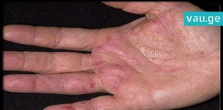 კიბოს პირველი სიმპტომი ხელზე ჩნდება. აი, რას უნდა დააკვირდეთ თქვენს ხელებზე