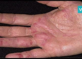 კიბოს პირველი სიმპტომი ხელზე ჩნდება. აი, რას უნდა დააკვირდეთ თქვენს ხელებზე