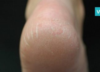 5 ყველაზე ეფექტური რეცეპტი, რომელიც თქვენს გამომშრალ და დამსკდარ ქუსლებს გააჯანსაღებს