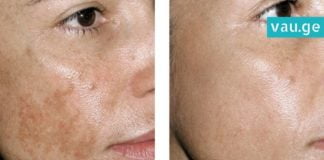 ფერიმჭამელებისა და პიგმენტური ლაქებისგან გათავისუფლების 5 სუპერეფექტური მეთოდი