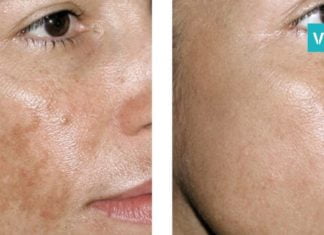 ფერიმჭამელებისა და პიგმენტური ლაქებისგან გათავისუფლების 5 სუპერეფექტური მეთოდი