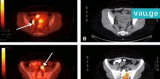 ამ ქალს კიბო ჰქონდა, მაგრამ მის ორგანიზმში ისეთი რამ აღმოაჩნეს, ამას ექიმიც არ ელოდა