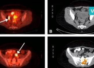 ამ ქალს კიბო ჰქონდა, მაგრამ მის ორგანიზმში ისეთი რამ აღმოაჩნეს, ამას ექიმიც არ ელოდა