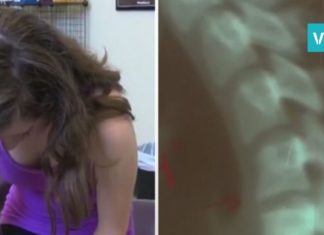 გოგონას კისრის არეში ქრონიკული ტკივილი აწუხებდა. დიაგნოზმა მისი მშობლები შეაშფოთა!