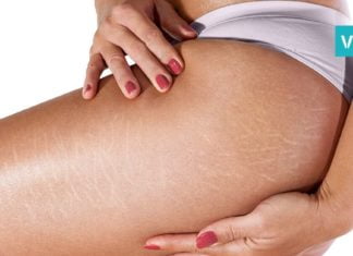 სტრიების მოსაშორებელი იდეალური საშუალება. ყველაზე სწრაფი და ეფექტური მეთოდია