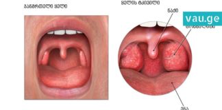 როგორ ვუმკურნალოთ ლარინგიტს? ეფექტური სიროფის მარტივი რეცეპტი