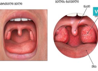 როგორ ვუმკურნალოთ ლარინგიტს? ეფექტური სიროფის მარტივი რეცეპტი