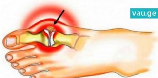 პოდაგრის მკურნალობა იოდითა და ასპირინით: 2 რეცეპტი… მე, უკვე, ეს პრობლემა მოვიშორე!