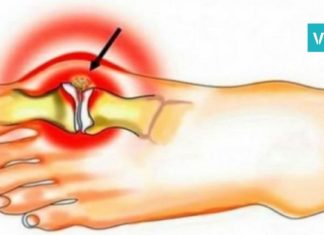 პოდაგრის მკურნალობა იოდითა და ასპირინით: 2 რეცეპტი… მე, უკვე, ეს პრობლემა მოვიშორე!