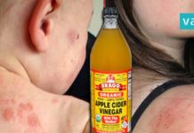 როგორ უნდა უშველოთ ეგზემას? ყველაზე ეფექტური ხერხი რაც აქამდე გსმენიათ