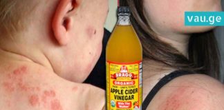 როგორ უნდა უშველოთ ეგზემას? ყველაზე ეფექტური ხერხი რაც აქამდე გსმენიათ