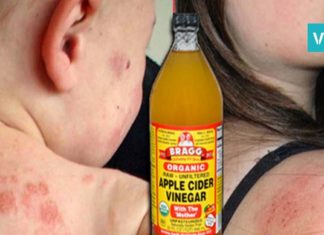 როგორ უნდა უშველოთ ეგზემას? ყველაზე ეფექტური ხერხი რაც აქამდე გსმენიათ