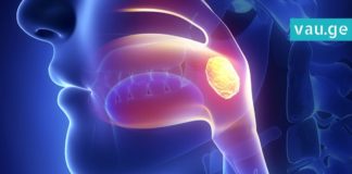 როგორ ვუმკურნალოთ ანგინას სახლის პირობებში-უმარტივესი რეცეპტი და შედეგი 4 საათში