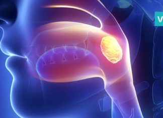 როგორ ვუმკურნალოთ ანგინას სახლის პირობებში-უმარტივესი რეცეპტი და შედეგი 4 საათში