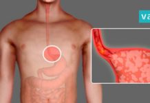 როგორ ვებრძოლოთ გულძმარვას? ყველაზე ეფექტური და საჭირო რჩევები