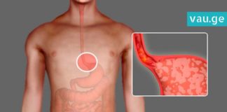 როგორ ვებრძოლოთ გულძმარვას? ყველაზე ეფექტური და საჭირო რჩევები