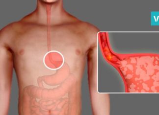 როგორ ვებრძოლოთ გულძმარვას? ყველაზე ეფექტური და საჭირო რჩევები