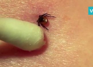 მწერის ნაკბენის დროს ეს ეფექტური ტექნიკა ყველაზე საიმედოა, ინფექციის რისკი ნულია !