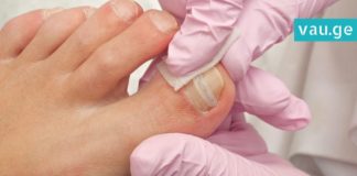 როგორ უნდა უმკურნალოთ ჩაბრუნებულ ფრჩხილს? სასარგებლო და ეფექტური რჩევები