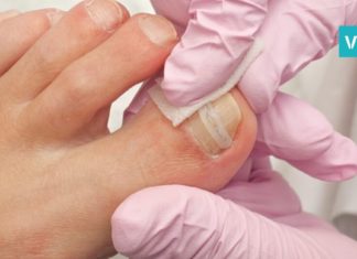 როგორ უნდა უმკურნალოთ ჩაბრუნებულ ფრჩხილს? სასარგებლო და ეფექტური რჩევები