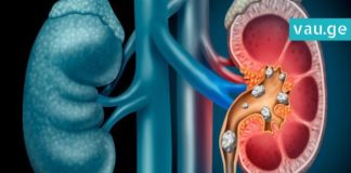 როგორ უნდა ებრძოლოთ თირკმელებში გაჩენილ ქვებს? 10 ყველაზე საჭირო რჩევა