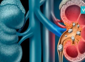 როგორ უნდა ებრძოლოთ თირკმელებში გაჩენილ ქვებს? 10 ყველაზე საჭირო რჩევა