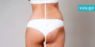 ცელულიტის საწინააღმდეგო ყველაზე ხელმისაწვდომი საშუალება. მარტივი და ეფექტურია!