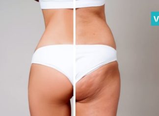 ცელულიტის საწინააღმდეგო ყველაზე ხელმისაწვდომი საშუალება. მარტივი და ეფექტურია!