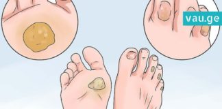 როგორ ვუმკურნალოთ კოჟრებს? 4 ყველაზე ეფექტური ხერხი, რომელიც კანს სწრაფად არბილებს