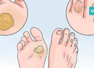 როგორ ვუმკურნალოთ კოჟრებს? 4 ყველაზე ეფექტური ხერხი, რომელიც კანს სწრაფად არბილებს