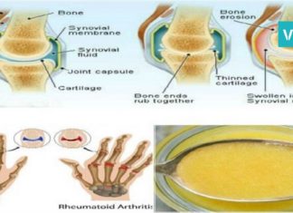 სამი საუკეთესო რეცეპტი ართრიტის სამკურნალოდ. მრავალჯერ ნაცადი და ეფექტური ხერხია
