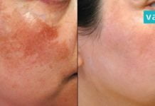 პიგმენტური ლაქების და ნაოჭების საწინაღმდეგო ყველაზე სწრაფი მეთოდი. იდეალურია