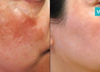 პიგმენტური ლაქების და ნაოჭების საწინაღმდეგო ყველაზე სწრაფი მეთოდი. იდეალურია