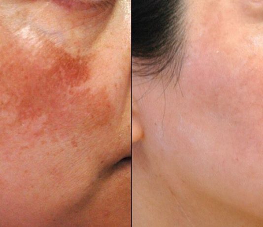 პიგმენტური ლაქების და ნაოჭების საწინაღმდეგო ყველაზე სწრაფი მეთოდი. იდეალურია