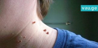 როგორ უნდა გამოიყენოთ ვაშლის ძმარი ხორცმეტების მოსაშორებლად- სასარგებლო რჩევები!