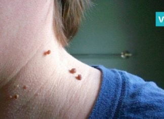 როგორ უნდა გამოიყენოთ ვაშლის ძმარი ხორცმეტების მოსაშორებლად- სასარგებლო რჩევები!