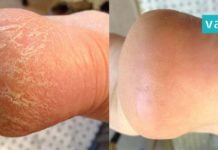 7 მეთოდი გაუხეშებული და დამსკდარი ქუსლების მოსარჩენად. ის, რაც თქვენ გჭირდებათ!