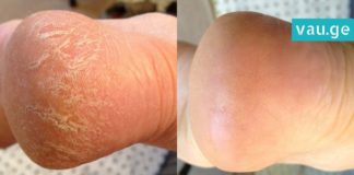 7 მეთოდი გაუხეშებული და დამსკდარი ქუსლების მოსარჩენად. ის, რაც თქვენ გჭირდებათ!