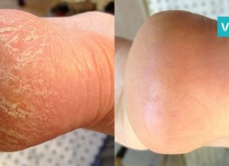 7 მეთოდი გაუხეშებული და დამსკდარი ქუსლების მოსარჩენად. ის, რაც თქვენ გჭირდებათ!