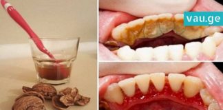 როგორ მოვიშოროთ კბილებიდან ქვები და ნადები მარტივად? ეს მეთოდი დაგეხმარებათ!