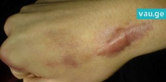 როგორ უნდა გააქროთ კანიდან შრამი? ყველაზე ეფექტური და სანდო მეთოდებია