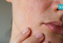 ინგრედიენტი, რომელიც სახის ღია ფორებს შველის. ყველაზე ეფექტური მეთოდი