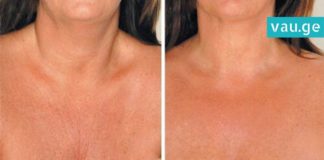 როგორ ვებრძოლოთ კისრის ნაადრევ დაბერებას – ამაში ეს ნიღაბი დაგეხმარებათ