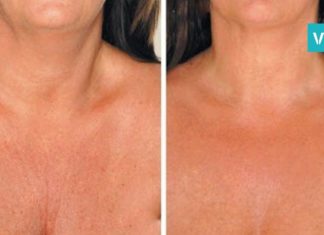 როგორ ვებრძოლოთ კისრის ნაადრევ დაბერებას – ამაში ეს ნიღაბი დაგეხმარებათ